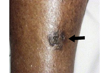 Squamous cell carcinoma can look like discrete areas of rough, raised skin that are darker than the patient’s skin tone | American Academy of Dermatology (AAD).