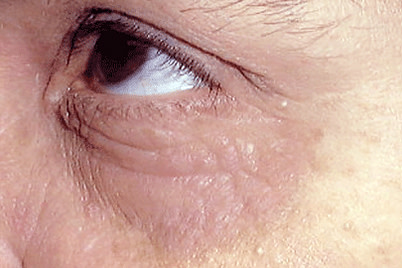 In adults, atopic dermatitis often develops on skin around the eyes.