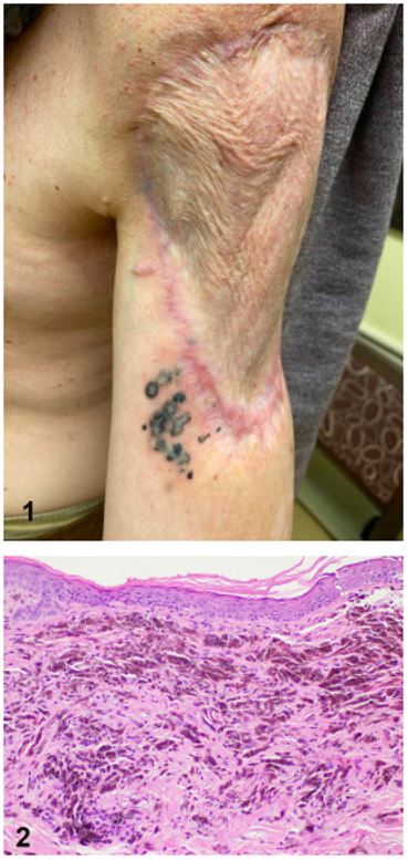 Images of tumoral melanosis for DWII