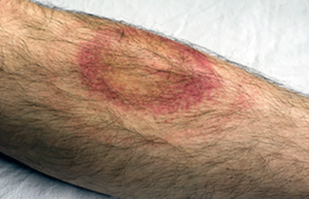 Rash from Lyme disease begins to clear on leg