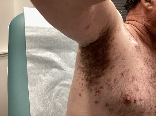 Follicular papulopustular eruption in a 61-year-old man with metastatic colon cancer treated with 5-fluorouracil, panitumumab, and trastuzumab deruxtecan