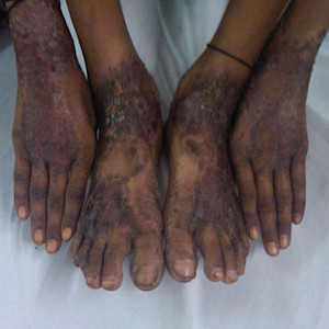 Image for DWII of skin showing signs of pellagra