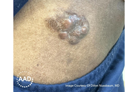 Dermatofibrosarcoma protuberans is a type of skin cancer that often looks like a skin-colored, firm bump that is growing. 