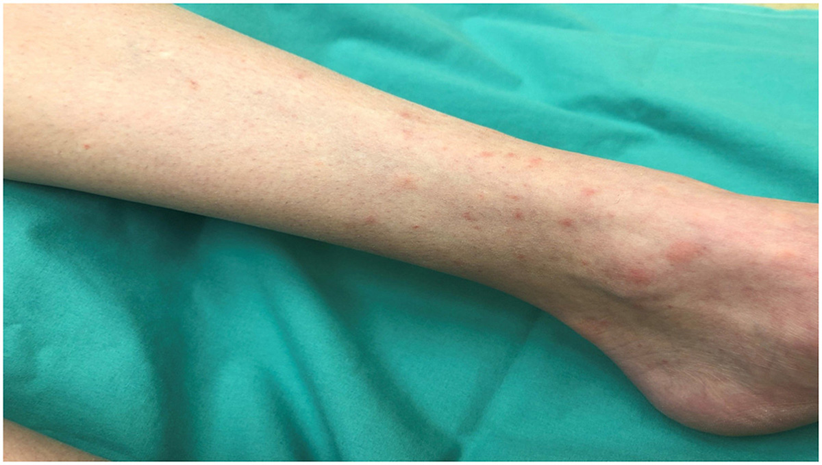 Image for DWII of cystic fibrosis signs on the skin 