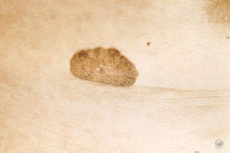 Seborrheic keratoses: Overview