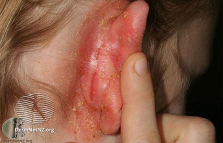 Scabies On Face And Scalp