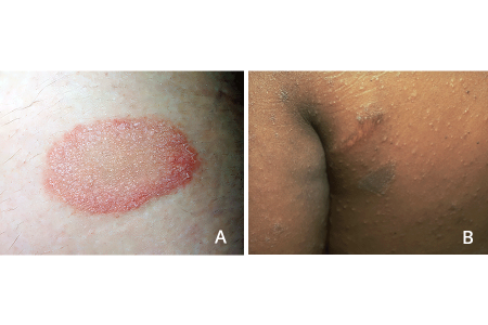 Herald patch on light skin tone (A). Herald patch and bumps on darker skin tone (B).