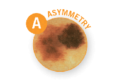 melanoma asymmetry border cancer skin