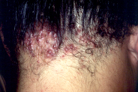 Large pimple-like bumps on back of scalp due to acne keloidalis nuchae