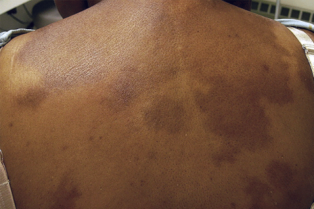Scleroderma patches of hard, thickened skin on the back