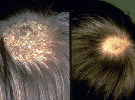 Ringworm infection on the scalp