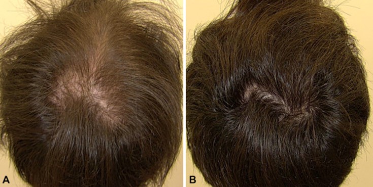 Illustration for DWII on low dose oral minoxidil for alopecia