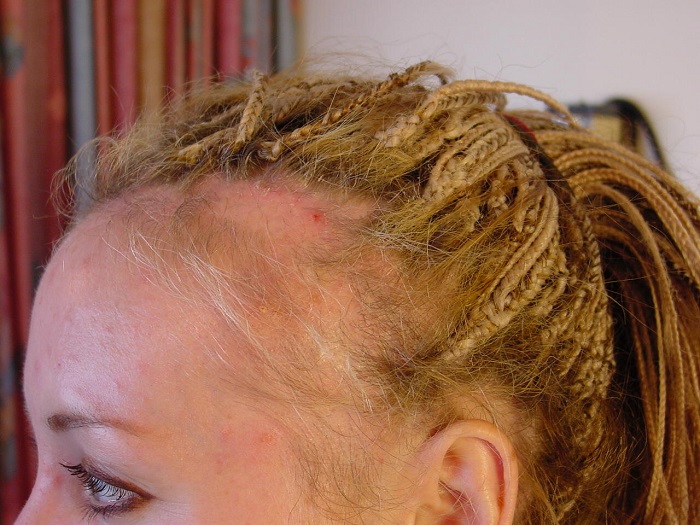 Woman with traction alopecia.