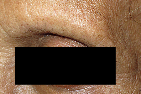 complete loss of eyebrow due to frontal fibrosing alopecia