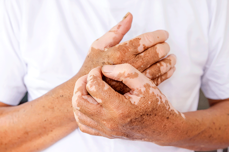 Vitiligo on hands