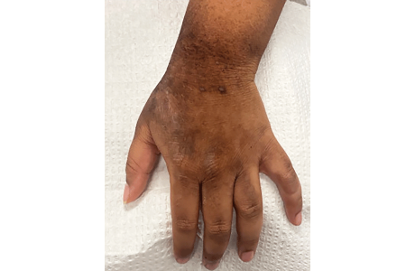 Atopic dermatitis on adult’s hand and wrist