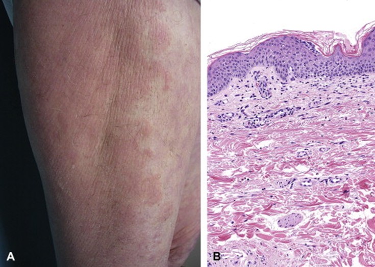 Image for DWII of urticarial dermatitis