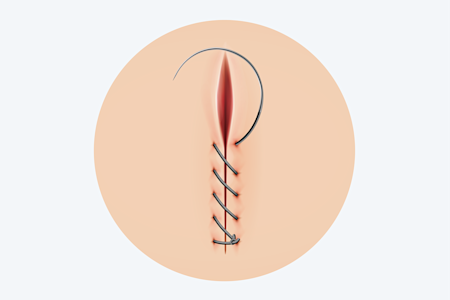 Card illustration for intermediate and complex repair