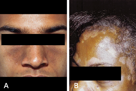 Seborrheic dermatitis rashes on darker skin tones