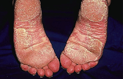 severe psoriasis on the bottom of feet