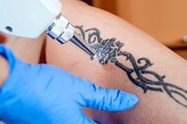 Image of a tattoo being removed by a dermatologist | American Academy of Dermatology (AAD)