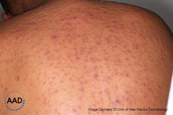 Varicella-zoster figure 4. Individual erythematous and crusted vesicles in a generalized distribution. Source: AAD.