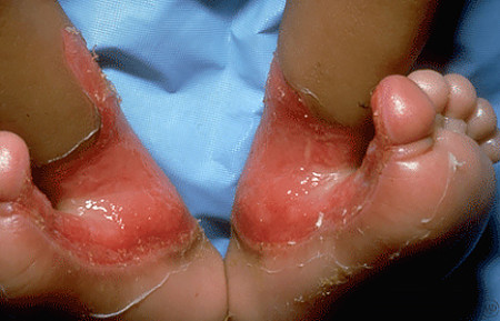 Epidermolysis bullosa on child's ankles and feet