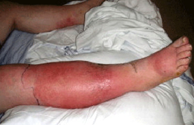 Cellulitis infection on a patient's lower leg