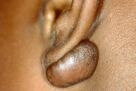 Keloid on a girl's earlobe