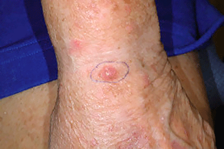 A reddish, scaly, and slightly raised spot on this patient's wrist is Merkel cell carcinoma