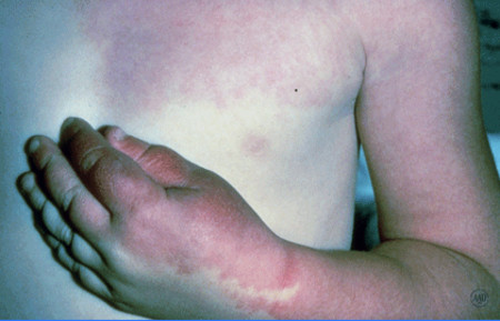 Port-wine stain on a child's arm and upper chest