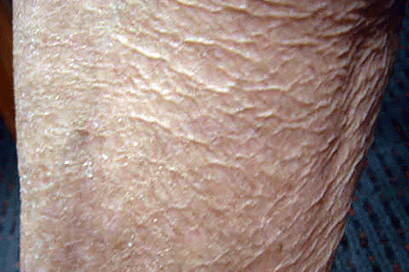 Close-up of severely dry skin