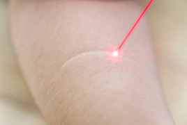 Scar treatment with laser