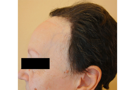 Hairline recedes several inches on scalp