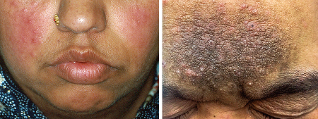 Red cheeks and acne-like breakouts due to rosacea (left), hyperpigmentation and acne-like breakouts due to rosacea (right)
