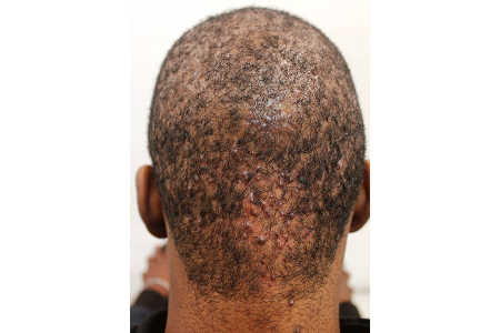 Black man with acne-like bumps on back of his neck