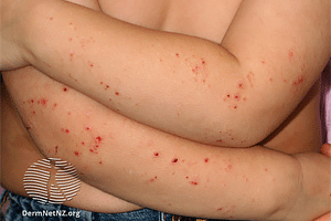 What causes little bumps on toddlers skin