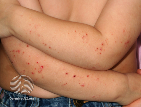 atopic dermatitis spots on arms