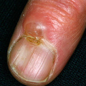 Card image of digital mucous cysts for DWII | American Academy of Dermatology (AAD)