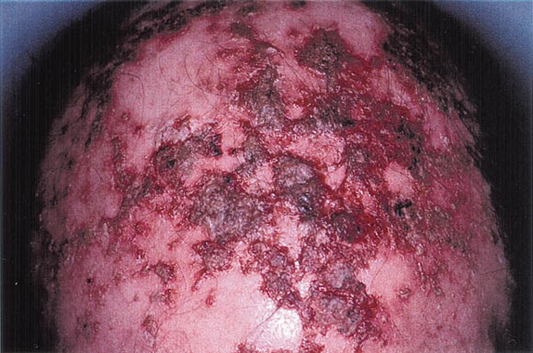 Illustration for DWII on contact pemphigus