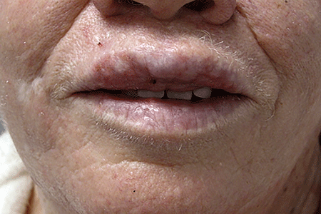 Actinic Keratosis Signs And Symptoms