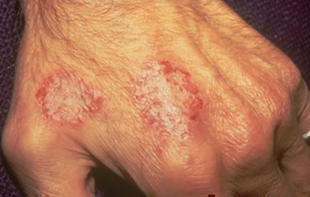 Two reddish round spots of nummular eczema on hand