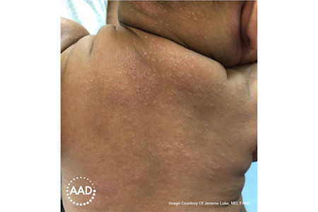 Small bumps in baby eczema rash