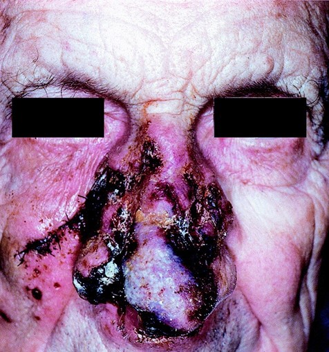 Image for recognizing cutaneous Balamuthia mandrillaris infection