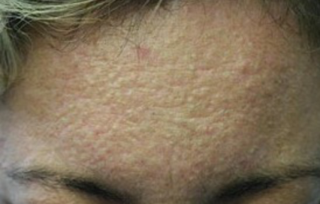 woman's forehead with whiteheads