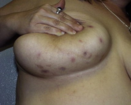 DWII image on Zuska disease