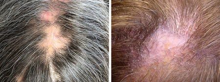 Lichen planopilaris caused patch of hair loss on patient’s scalp (left), Lichen planopilaris caused small bumps on scalp and hair loss (right)