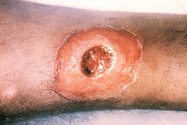 Figure 2. A diphtheria-mediated ulcerated plaque on a patient’s lower leg. C. diphtheriae infections frequent manifest as open wounds. Source: CDC. (3)