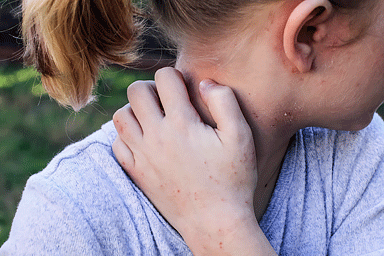 Close-up of a girl with eczema; atopic dermatitis visible on arm, hand, neck, ear, and part of face.