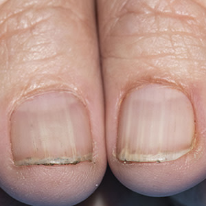 Image of nail changes for DWII on BAP1 tumor predisposition syndrome